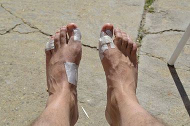 foot-blister